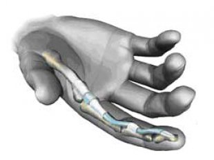 Симптомы перелома пальца на руке (признаки)